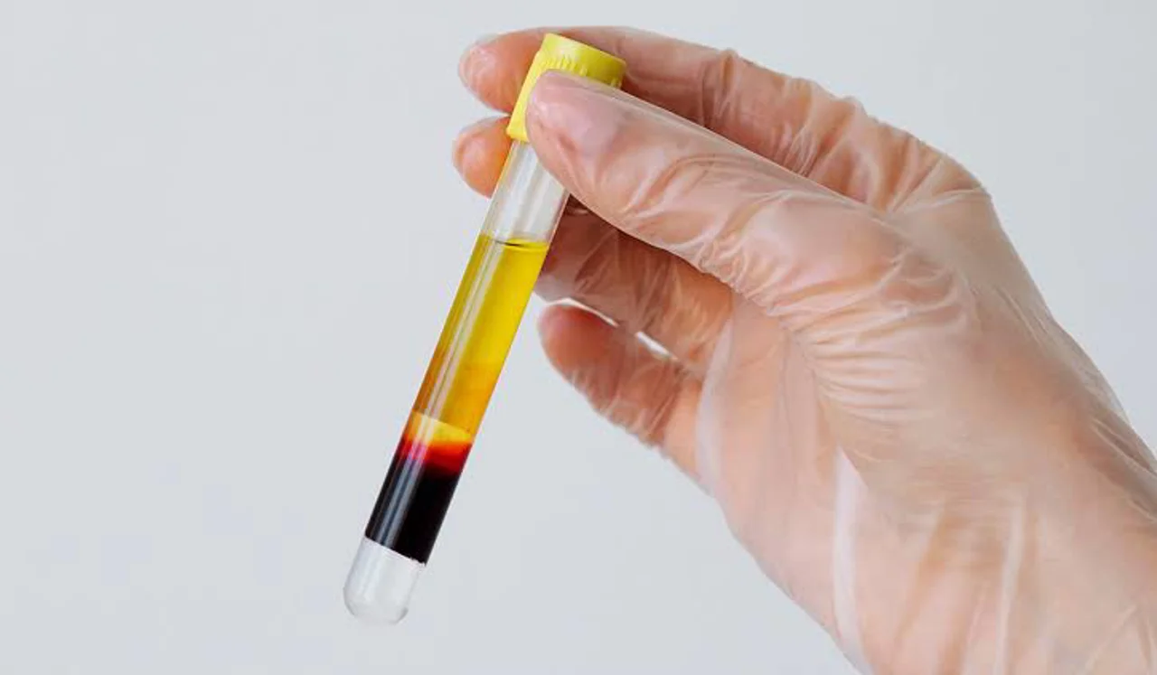 جدیدترین یافته ها در مورد PRP